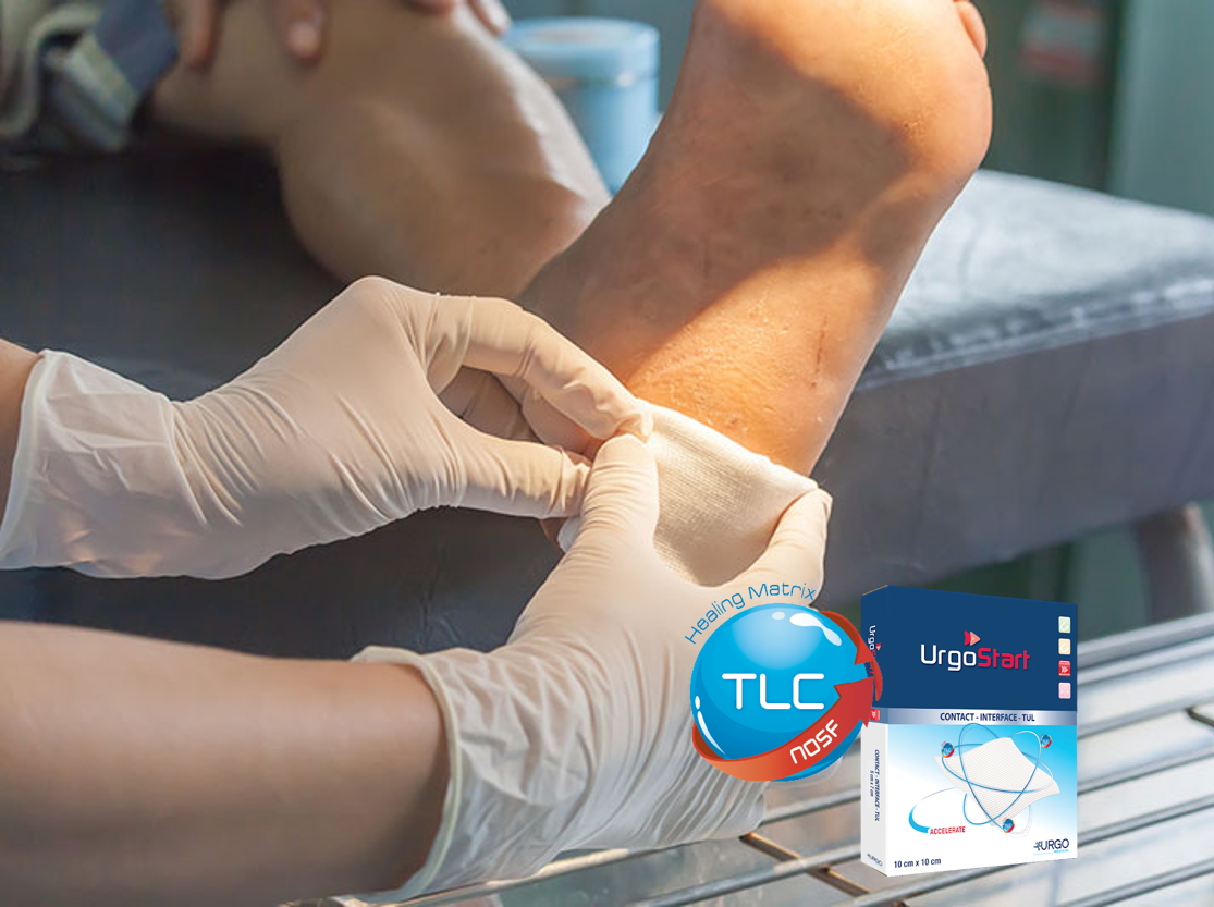 ¿Cuál es el Standard de tratamiento de Pie Diabético? Urgo